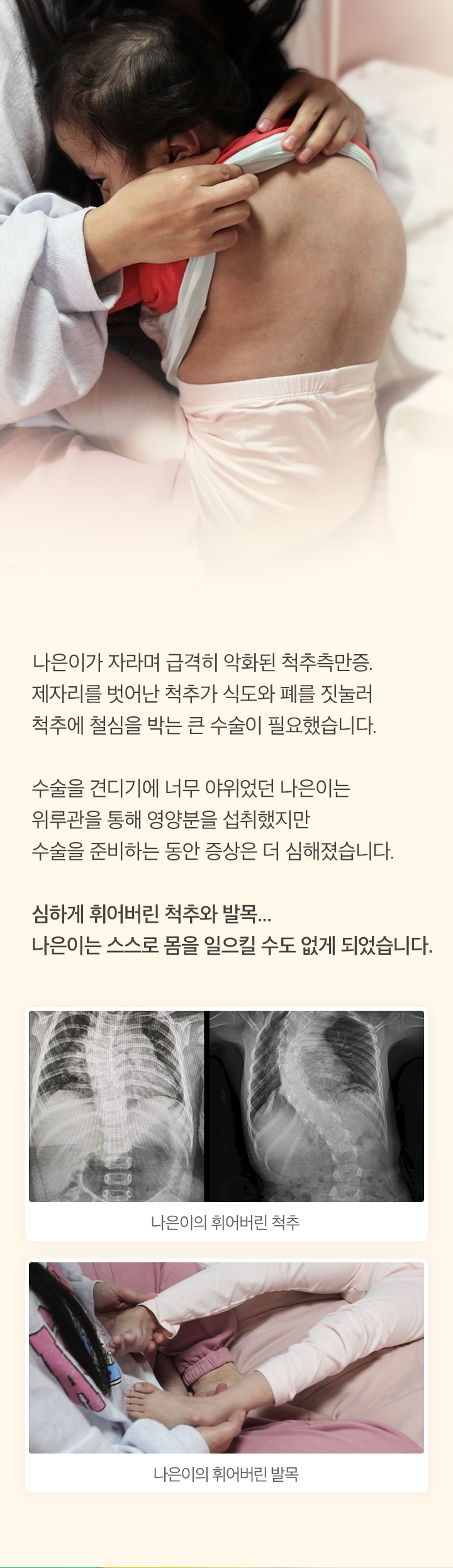 90도 이상 휘어버린 척추