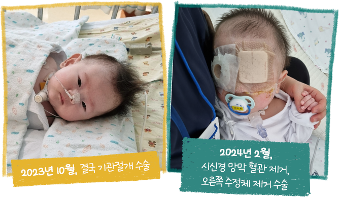 2023.10 결국 기관절개 수술, 2024.02 시신경 망막 혈관 제거오른쪽 수정체 제거 수술
